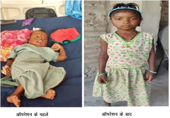 चिरायु योजना बच्चों के लिए भी बनी वरदान