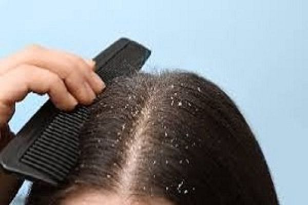 सर्दियों में बढ़ गई है बालों में रूसी की समस्या तो आजमाएं ये उपाय...