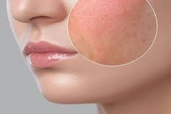 सर्दियों में ड्राय स्किन की देखभाल कैसे करें, आसान टिप्स और ट्रिक्स