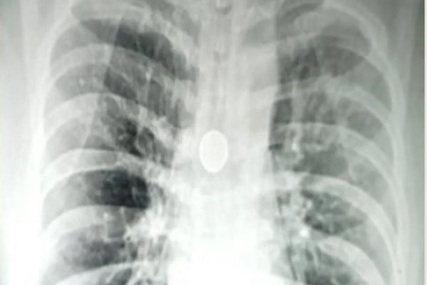 8 साल से सांस की नली में फंसा था 25 पैसे का सिक्का, बीएचयू के डॉक्टरों ने 20 मिनट में निकाला